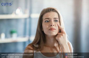 All of a Sudden: How to Deal with a Surprise Pimple