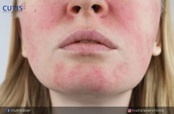 5 Things You Need to Know About Spider Veins on the Face