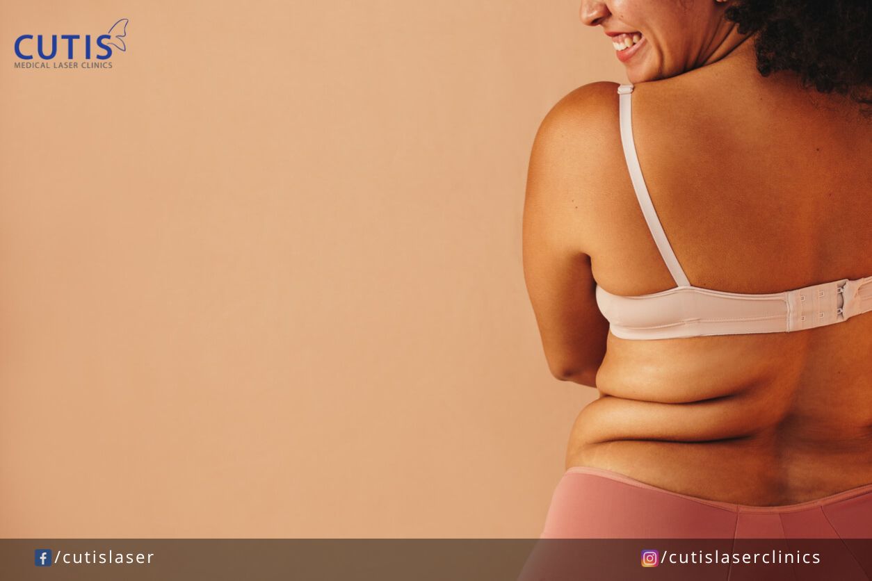 INFS  Bra bulge refers to the excess fat or skin, pushed out
