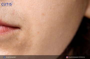 Peach Fuzz: How Can You Get Rid of It