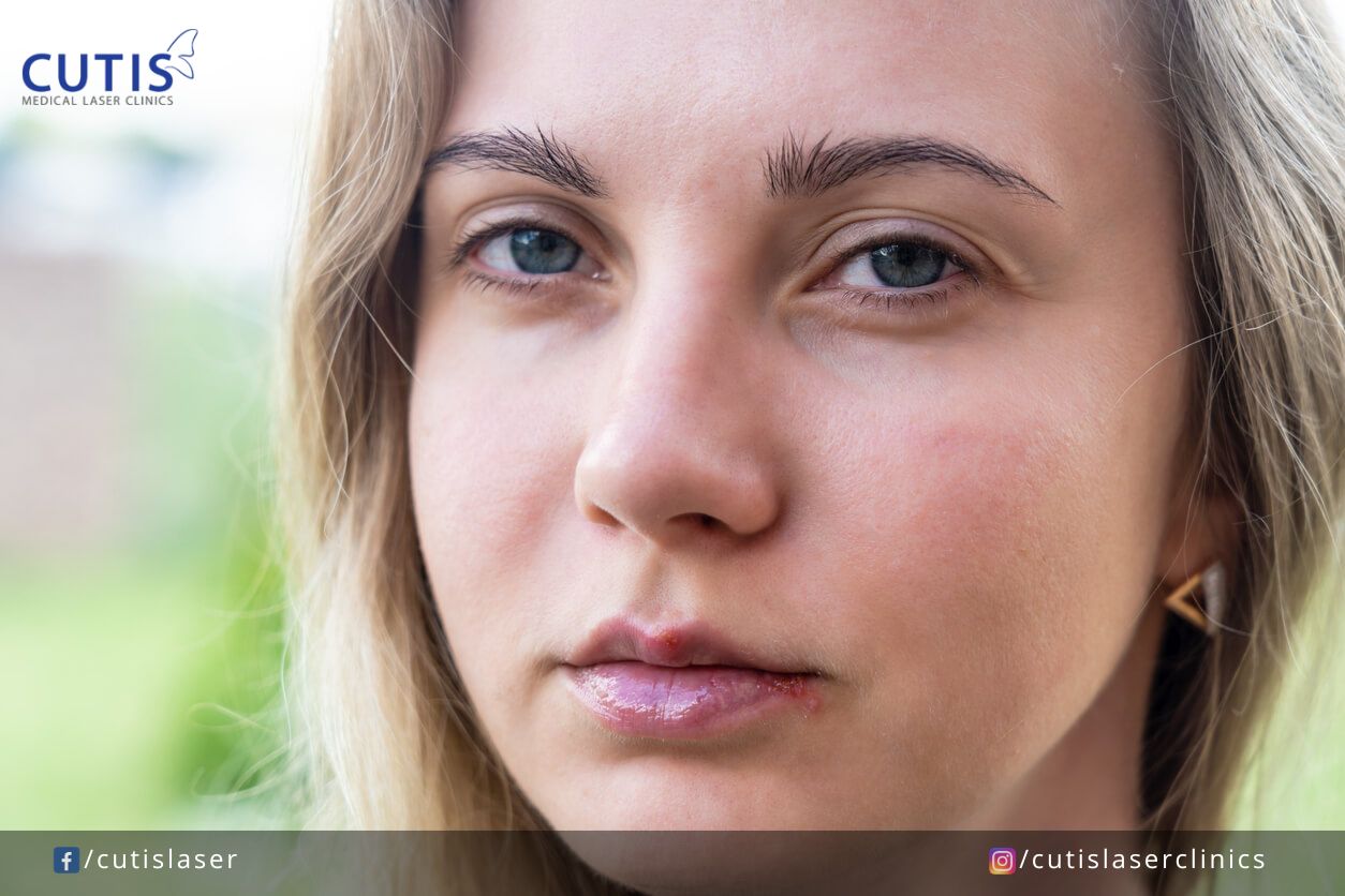 Stop Making Your Chapped Lips Worse