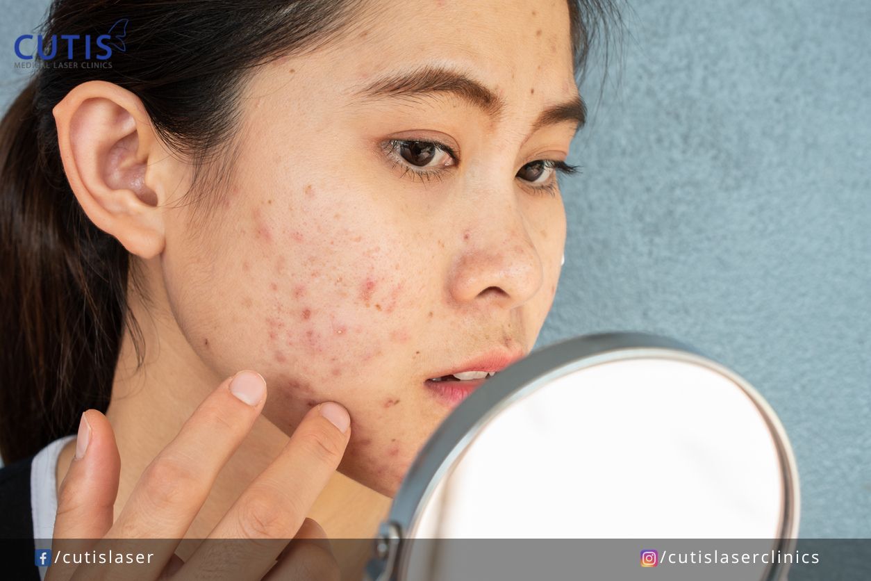 Do You Have Blemish-Prone Skin?