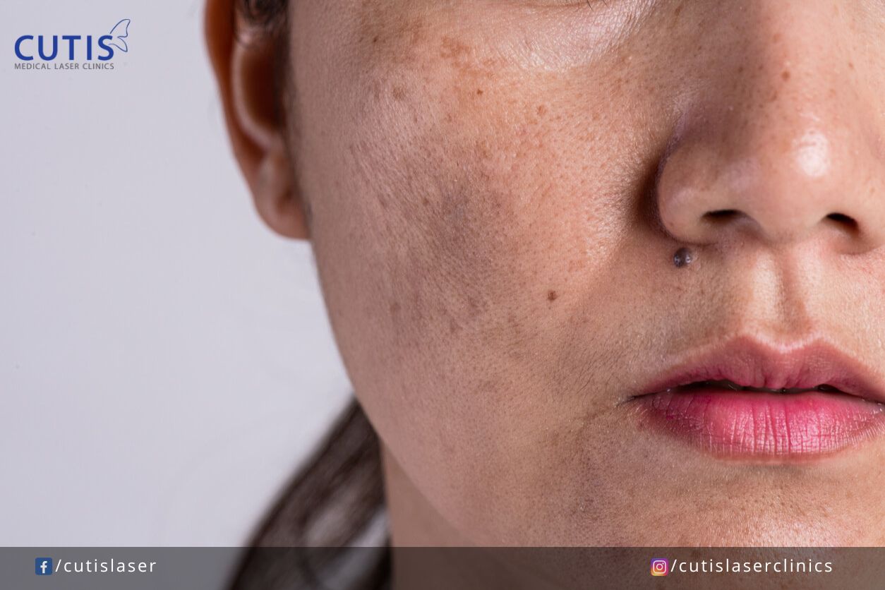 Fading Dark Spots: Do Laser Treatments for Pigmentation Work?