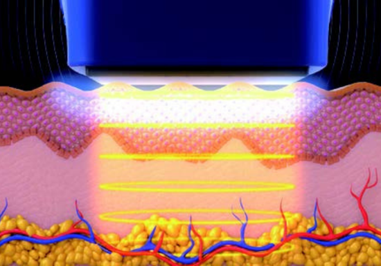 10Therma - How it works