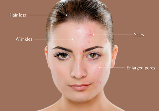 Conditions that microneedling treat or improve