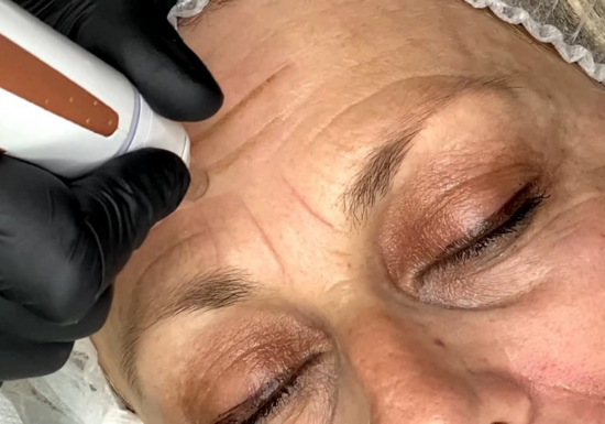 DEEP DERMAL REMODELING: plasmaTIP®