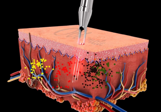 Wrinkle Treatment in Singapore