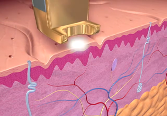 How does Laser skin rejuvenation work