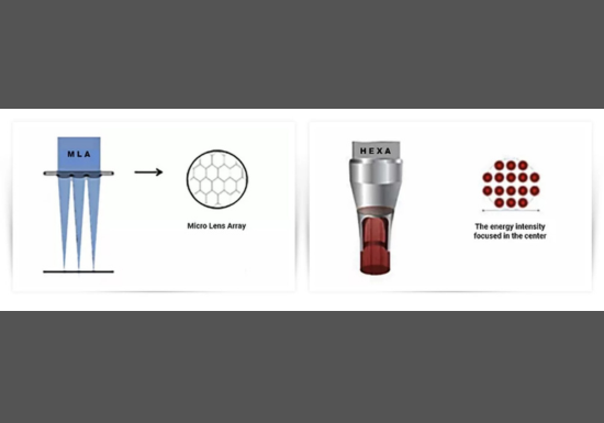 HEXA MLA - Uneven Skin Texture