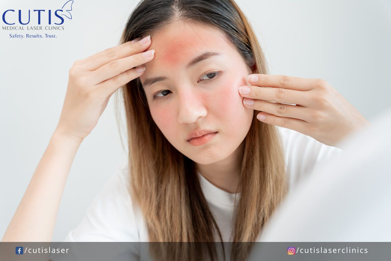 Facial Flushing: Is it Just Normal Redness or Rosacea?