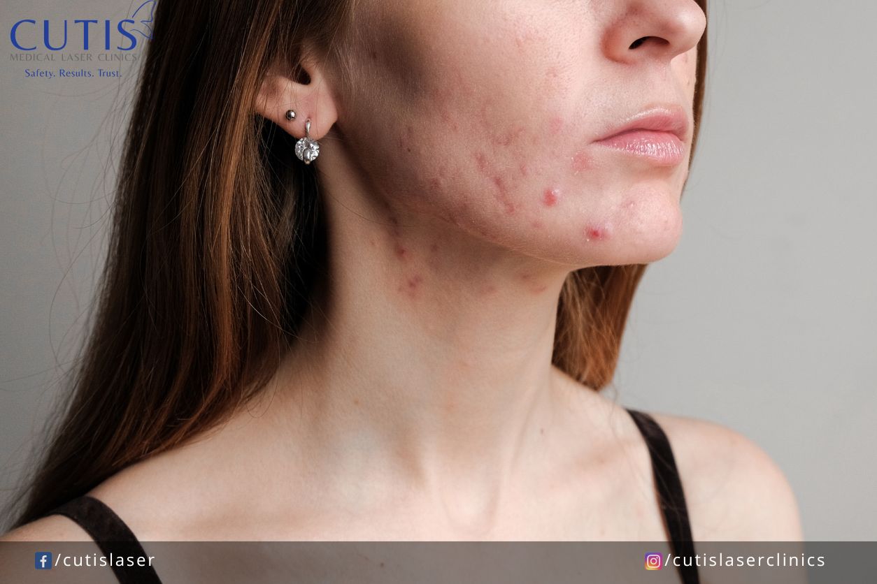 Congested Skin: Causes, Symptoms, and Treatments