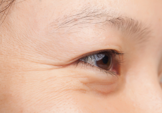 Aging around the eyes and face