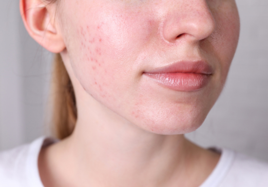 Acne & Acne Scars