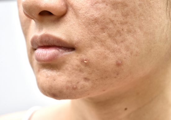 Acne & Acne Scars Treatments Singapore