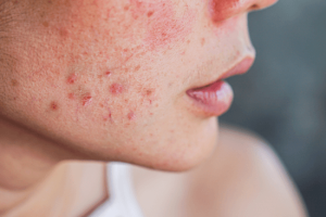 Clarifying Facial with DiamondTome and Sapphire Blue Light Therapy