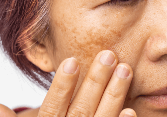 Pigmentation Treatments