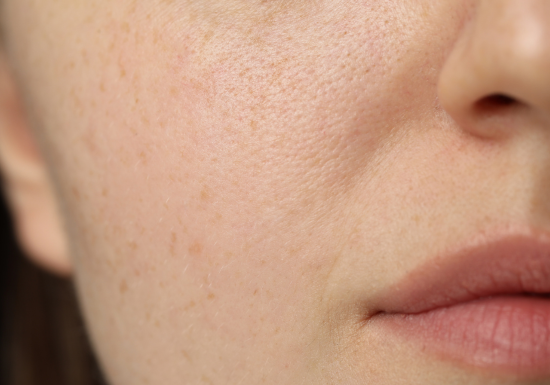 Treat Premature aging skin