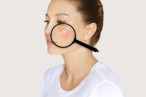 Benefits of laser vein reduction