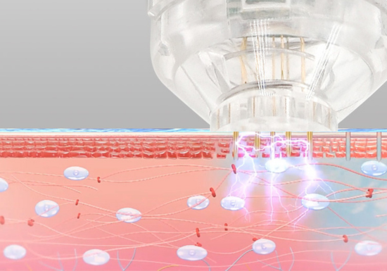 EPN Professional Microneedling Pen