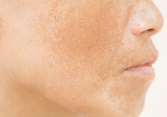 Medical Pigmentation Treatments