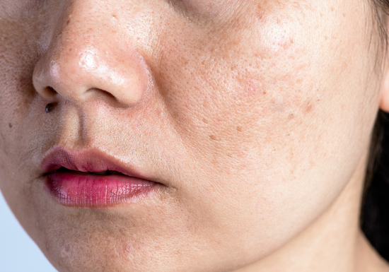 Pigmentation