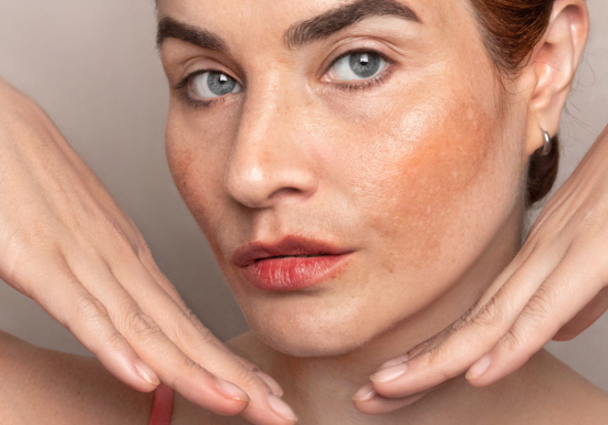 Pigmentation