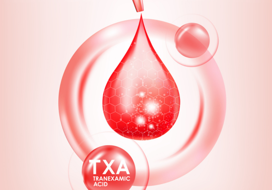 Oral tranexamic acid for melasma