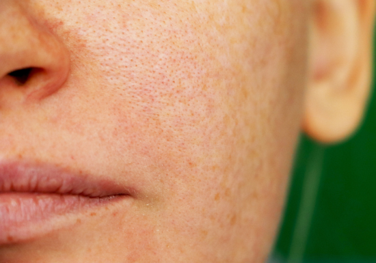 Sun Damage Pigmentation Treatment