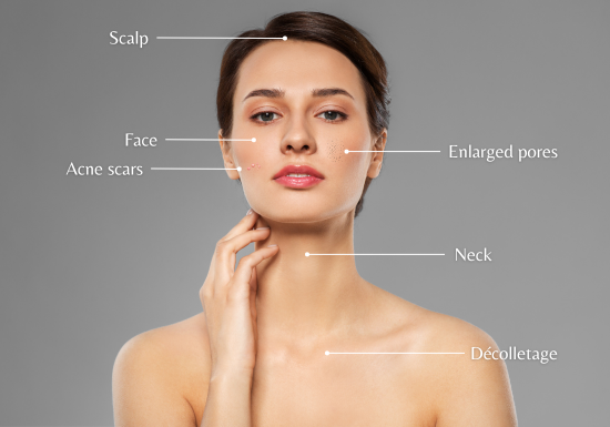 EPN Plus Microneedling with Electroporation