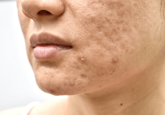 Chemical peel for acne and skin exfoliation