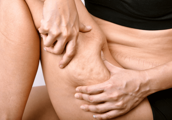 CoolSculpting Elite fat freezing