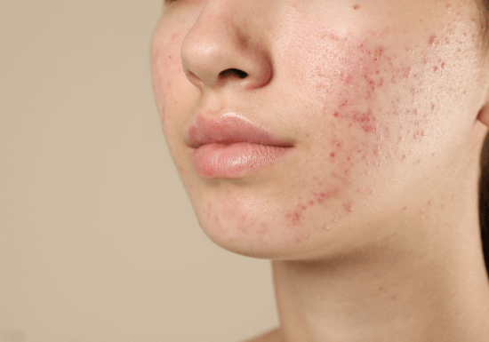 Hydra Clarifying Facial for deep-cleaning and hydration