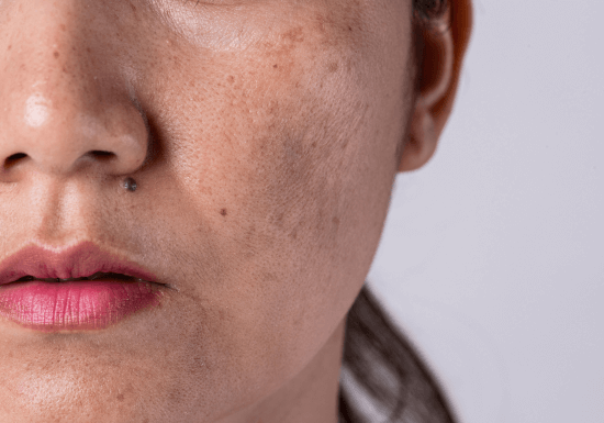 Pigmentation Singapore