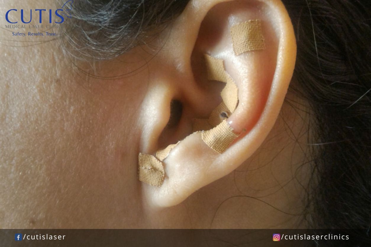 What is Ear Seeding & Why are Influencers Using it for Facial Contouring?