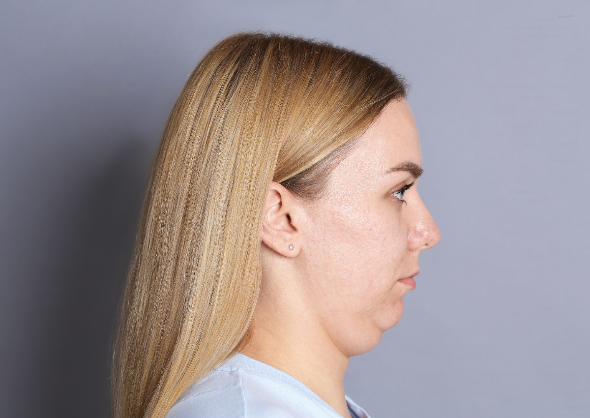 Lower Face Sagging Treatment: Non-Surgical Lifting Options in Singapore