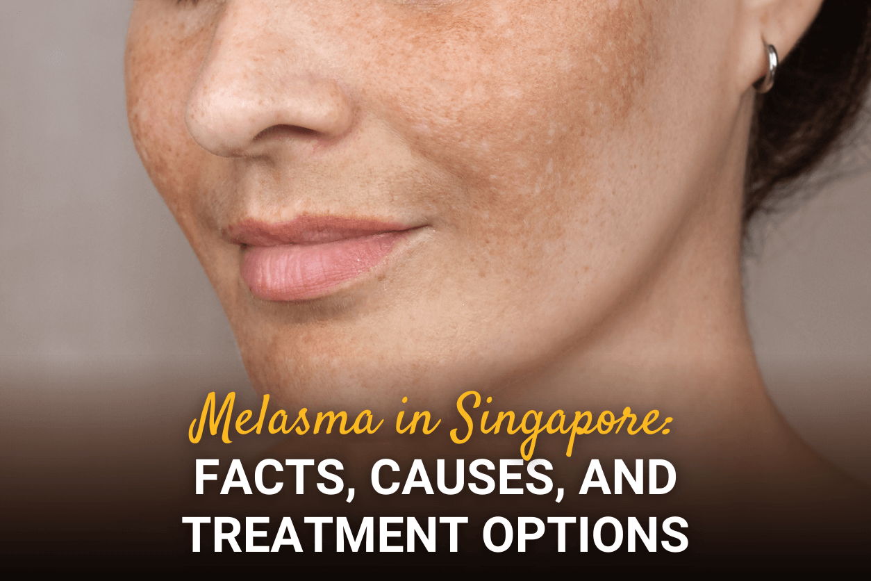 Melasma in Singapore: Facts, Causes, and Treatment Options