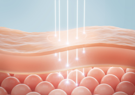 What is radiofrequency skin tightening?
