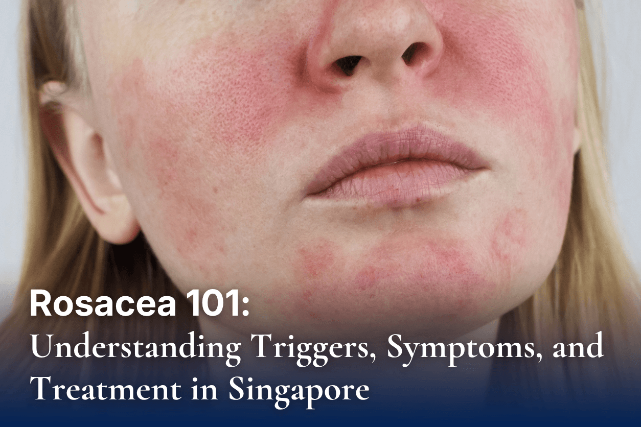 Rosacea 101: Understanding Triggers, Symptoms, and Treatments in Singapore