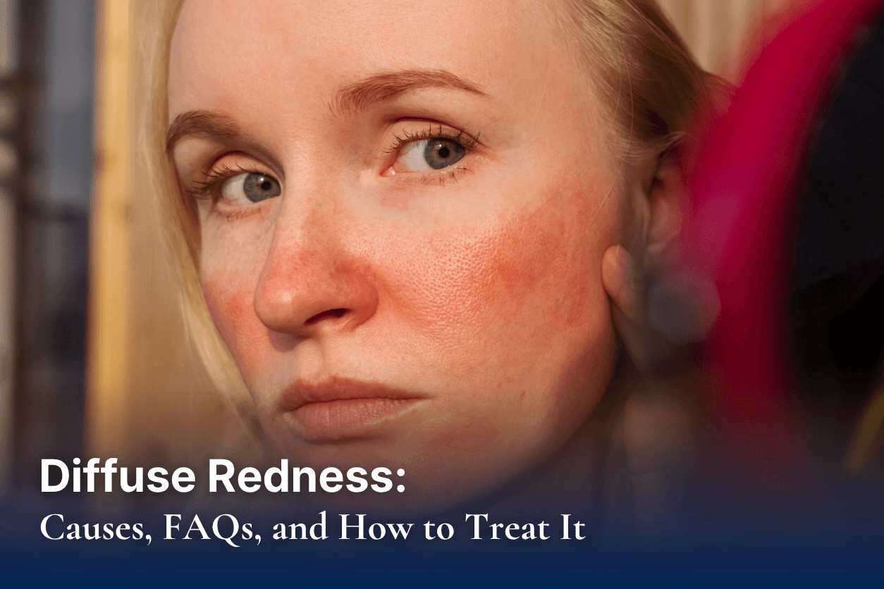 Diffuse Redness: Causes, FAQs, and How to Treat It